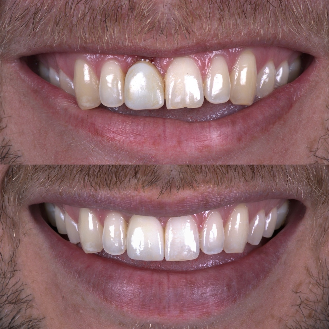 Cosmetic dentistry in Boulder, CO