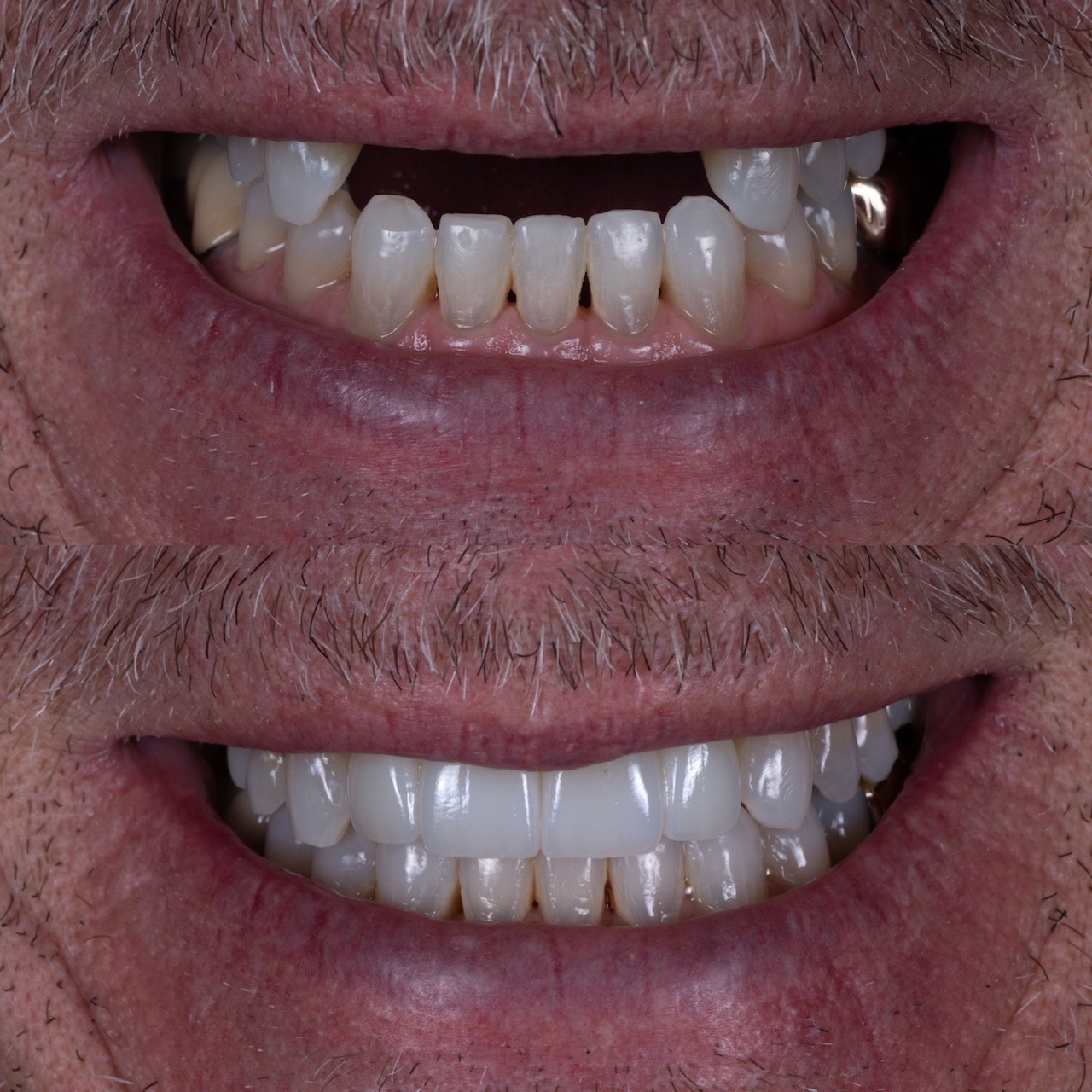 Dental Veneers in Boulder, CO