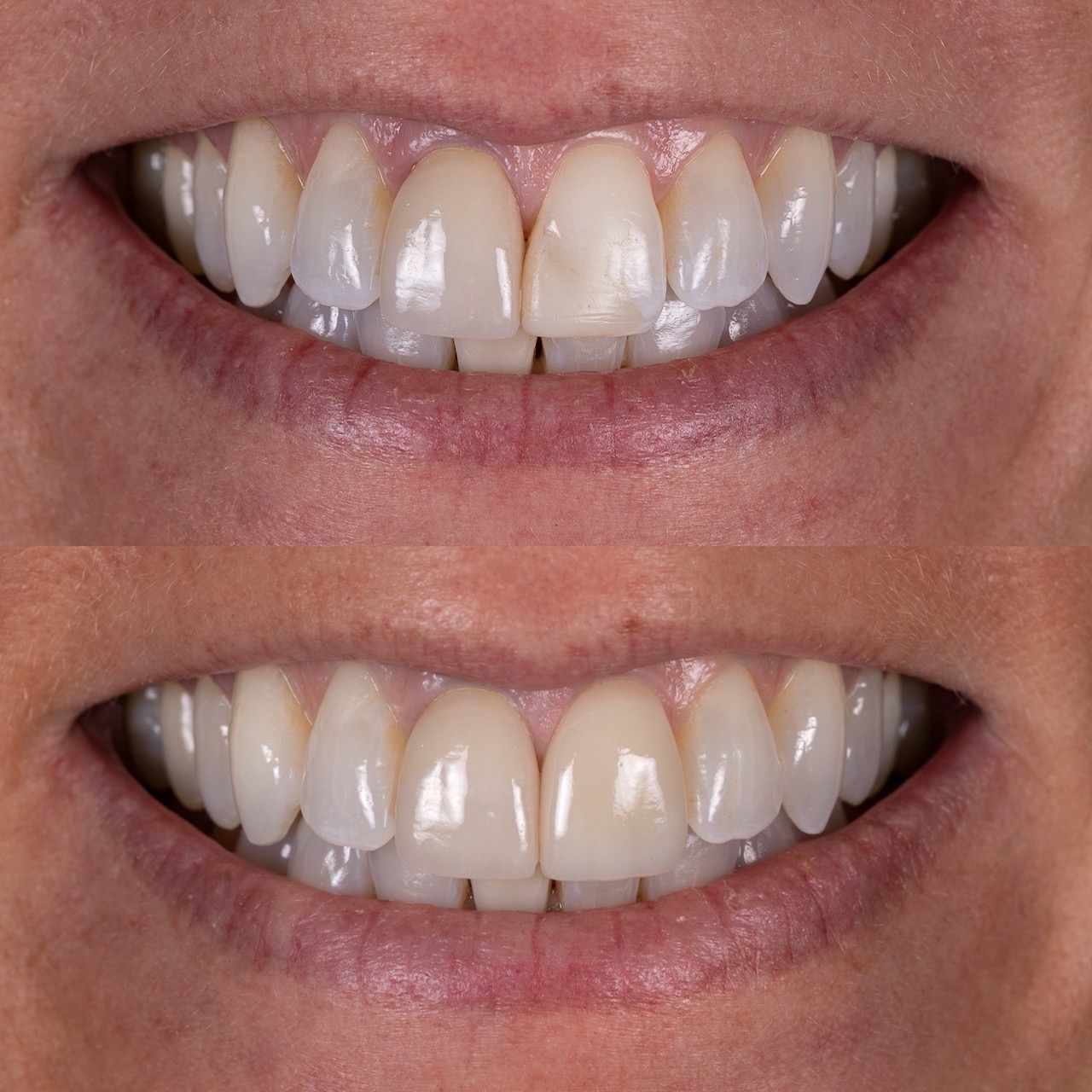 Cosmetic dentistry in Boulder, CO
