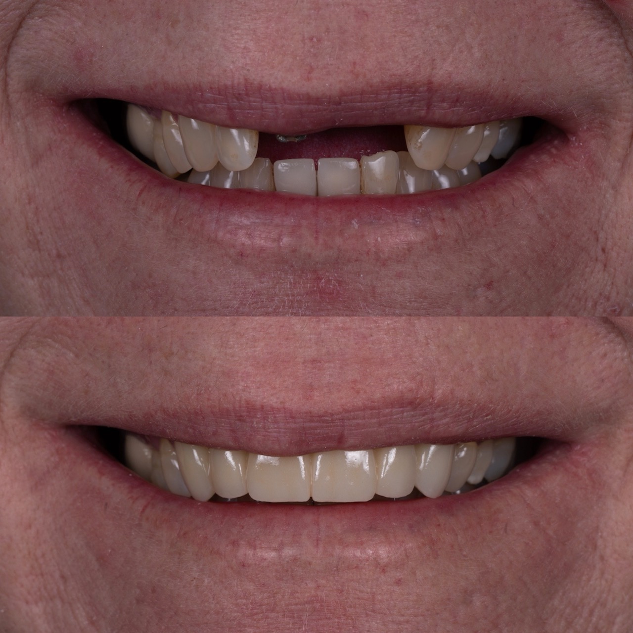 Dental veneers in Boulder, CO