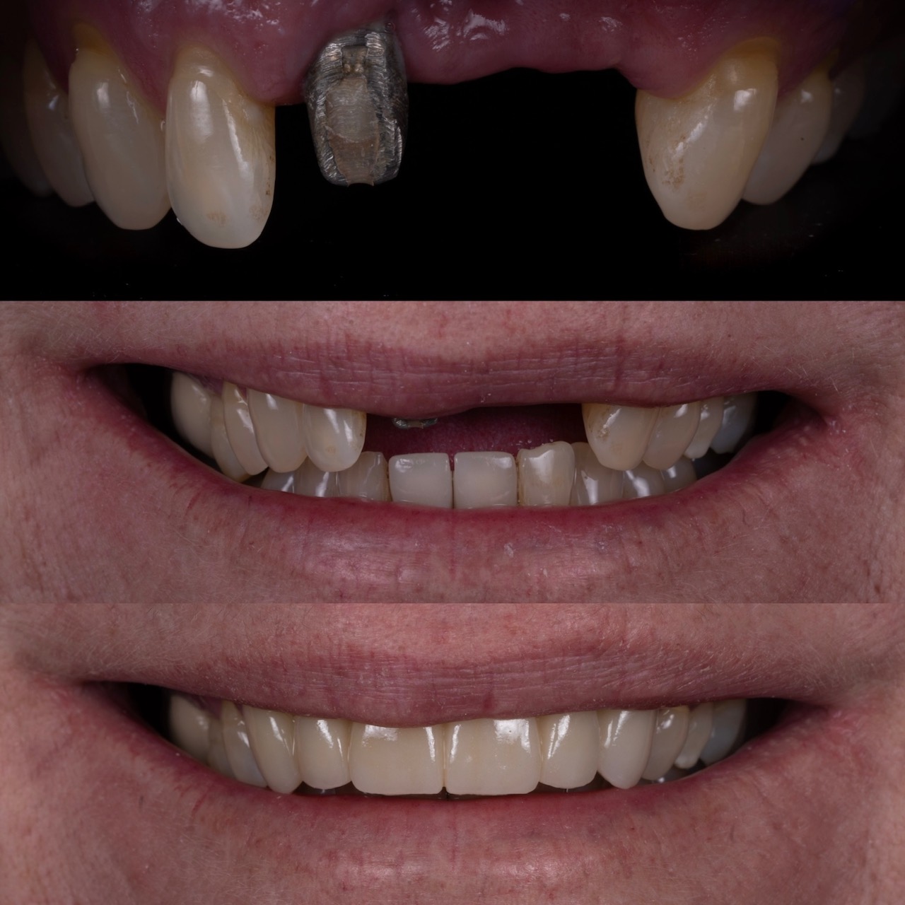 Dental veneers in Boulder, CO